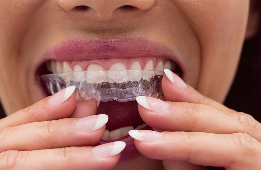 Mulher encaixando alinhador transparente Invisalign nos dentes, close na boca e nas mãos.