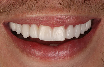 Dra Debora Reis – Lentes Dentais Close no sorriso masculino com acabamento uniforme e estético das lentes dentais