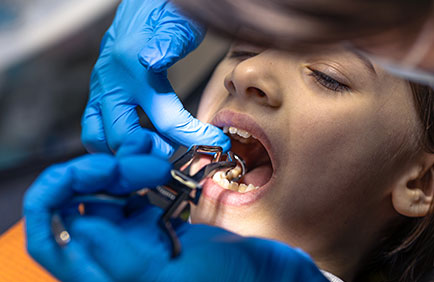 Dra Debora Reis – Exodontia | Extração do siso Extração de dente em paciente com auxílio de alavanca odontológica