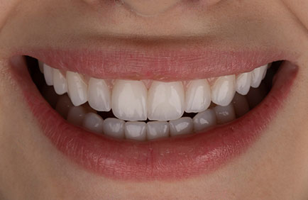 Dra. Débora Reis – Franciny Ehlke – Lentes de contato dental Franciny Ehlke - Lentes de contato dental